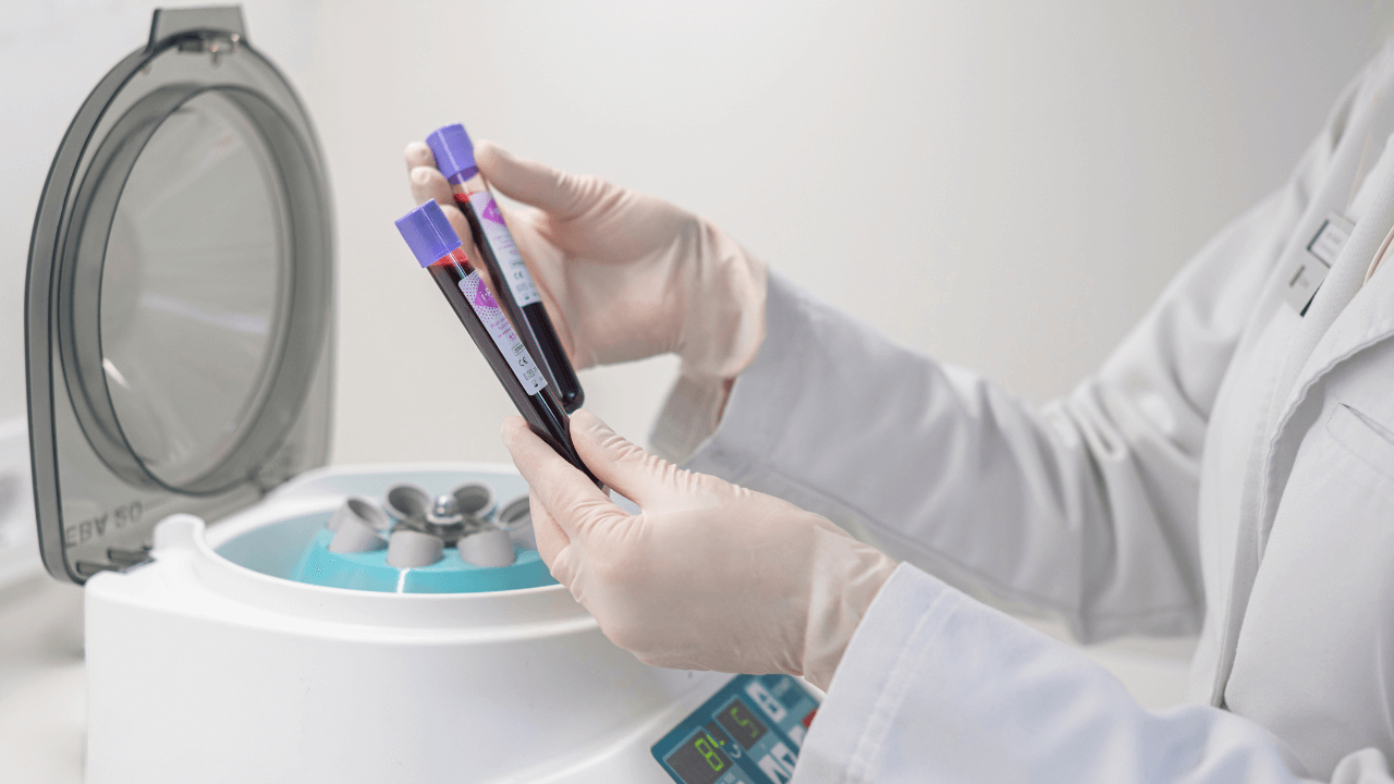 PRP terapija plaukams