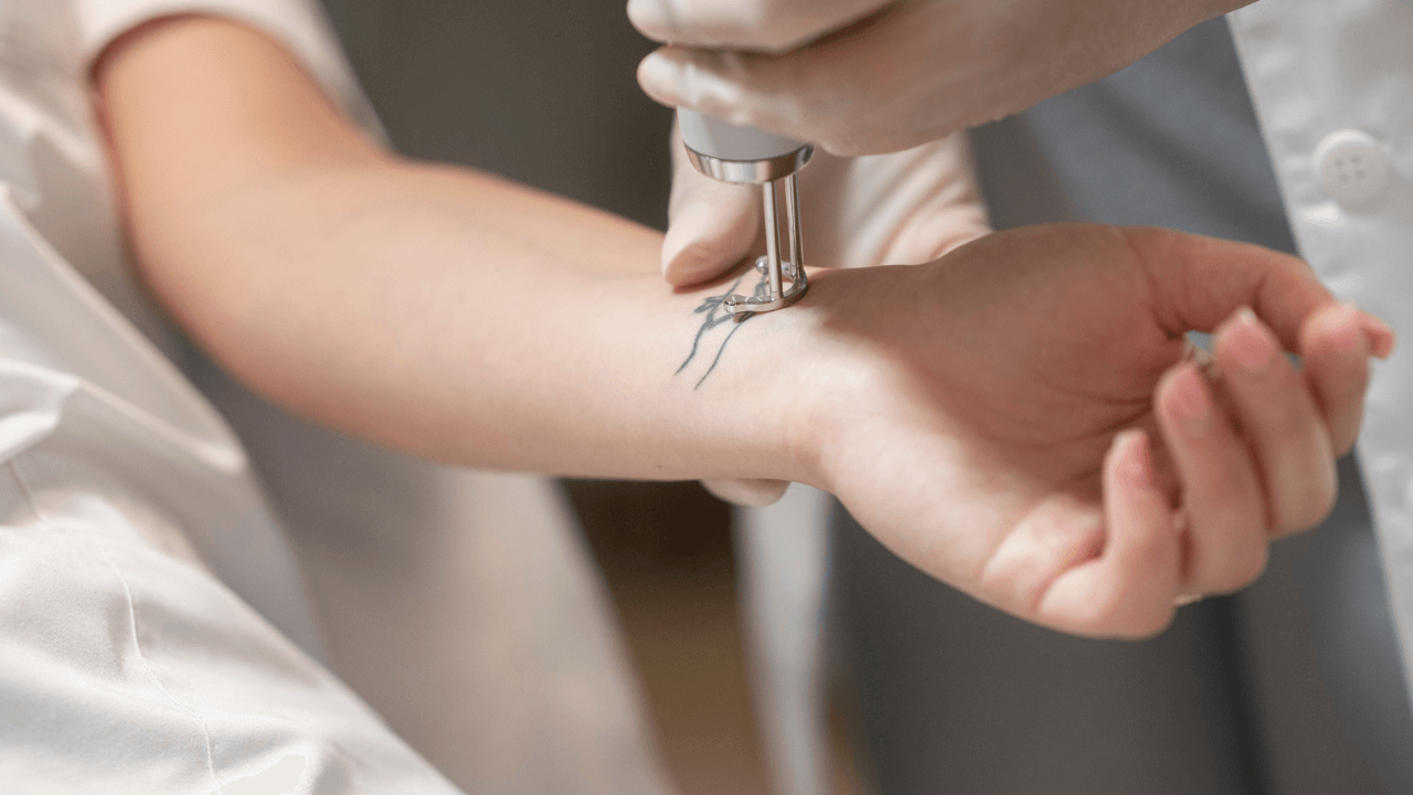 Tatuiruočių / permanentinio makiažo šalinimas lazeriu