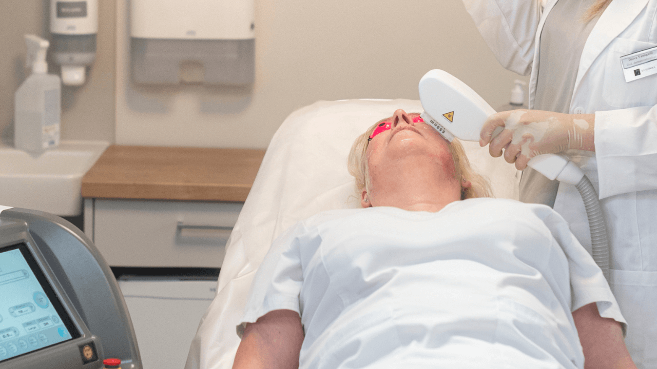 Difuzinio raudonio (rožinės), aknės, hiperpigmentacijos gydymas